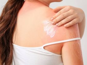 چگونه می توان از آفتاب سوختگی جلوگیری کرد؟