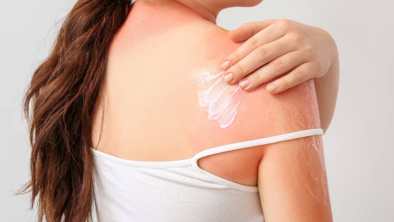چگونه می توان از آفتاب سوختگی جلوگیری کرد؟