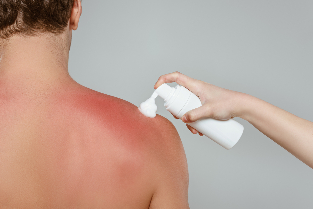 چگونه می توان از آفتاب سوختگی جلوگیری کرد؟