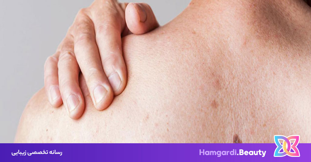 لکه های پوستی کبدی، علل، تشخیص و روش‌های درمان