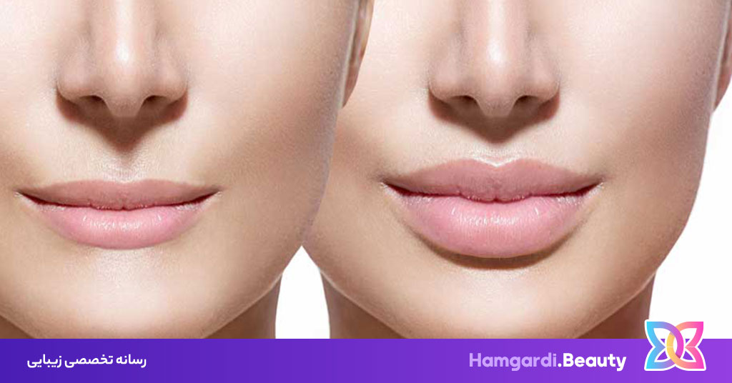 تفاوت ژل و فیلر، آشنایی با دو روش زیبایی پرکاربرد