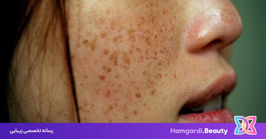 چرا کک و مک پوستی به وجود می آید؟