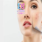 درمان خانگی جوش؛ راهکارهایی ساده برای پوستی صاف و بدون التهاب