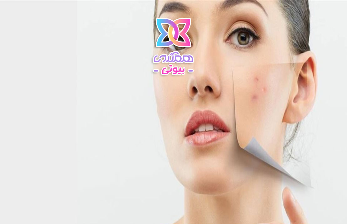 درمان خانگی جوش؛ راهکارهایی ساده برای پوستی صاف و بدون التهاب