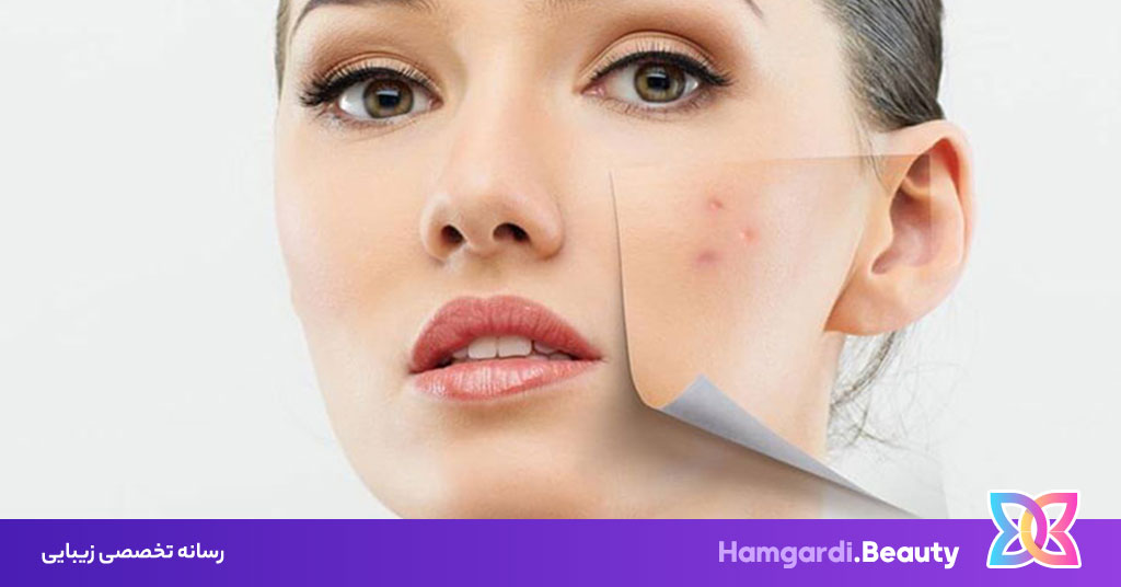 درمان خانگی جوش؛ راهکارهایی ساده برای پوستی صاف و بدون التهاب